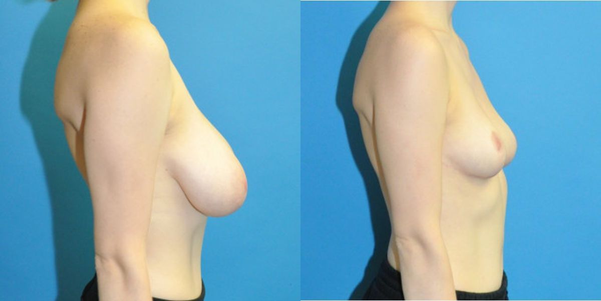 Breast Reduction #20 - Before and After