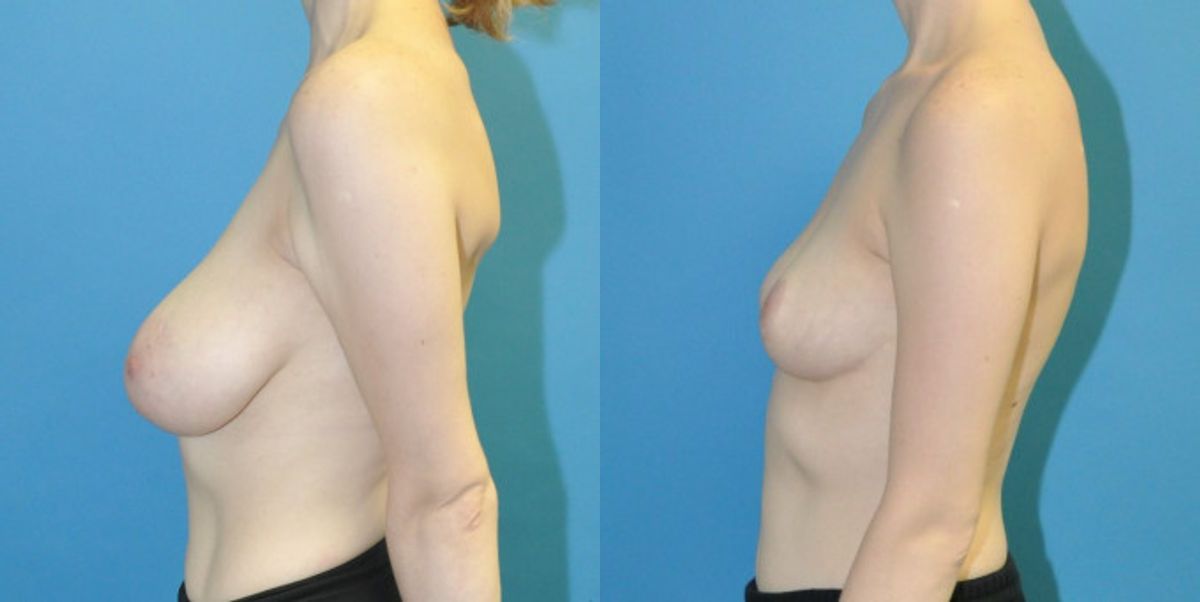 Breast Reduction #20 - Before and After