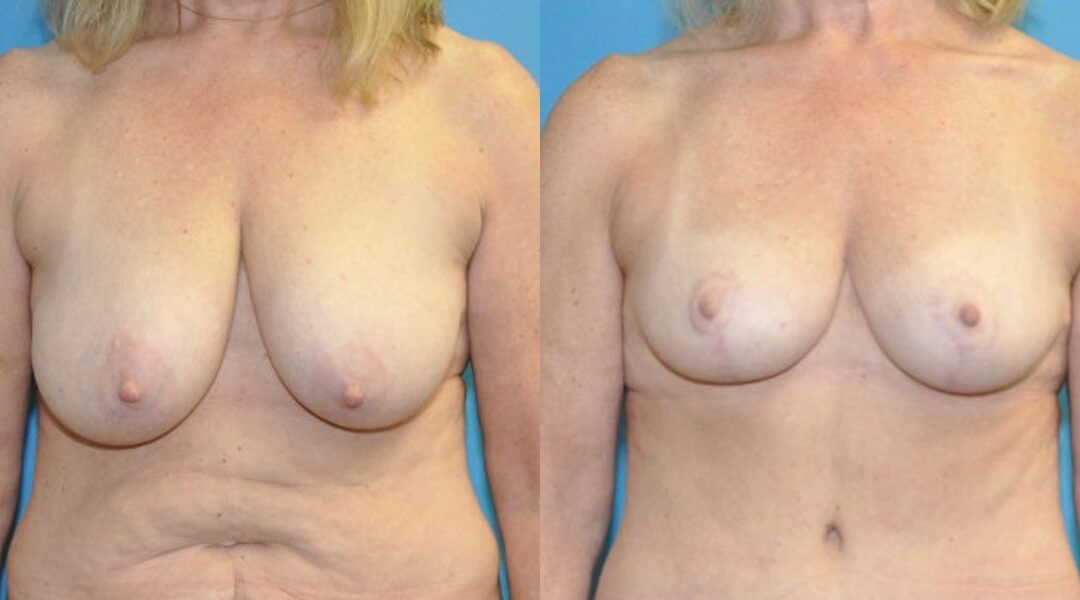 Breast Reduction #21