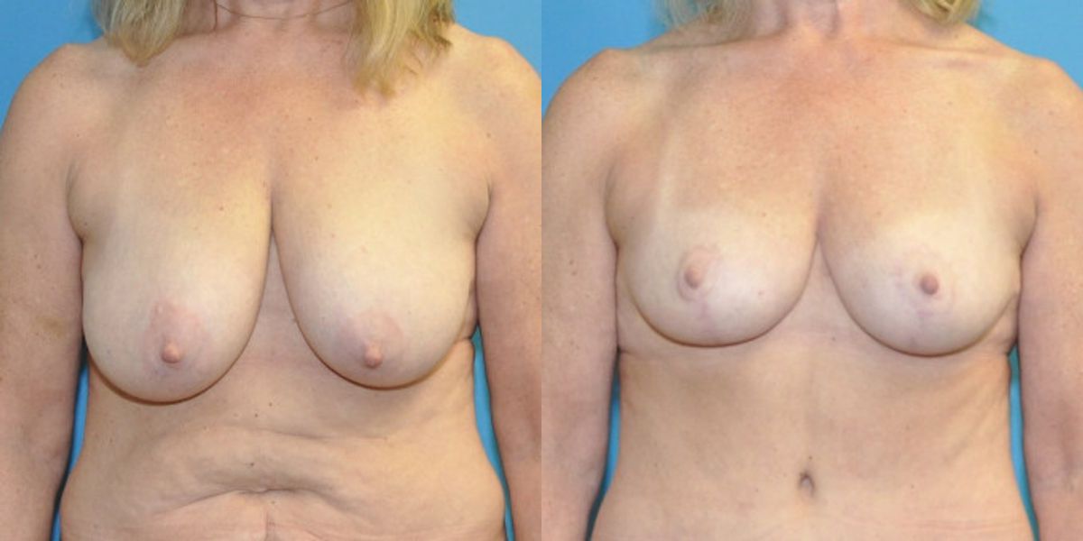 Breast Reduction #21 - Before and After
