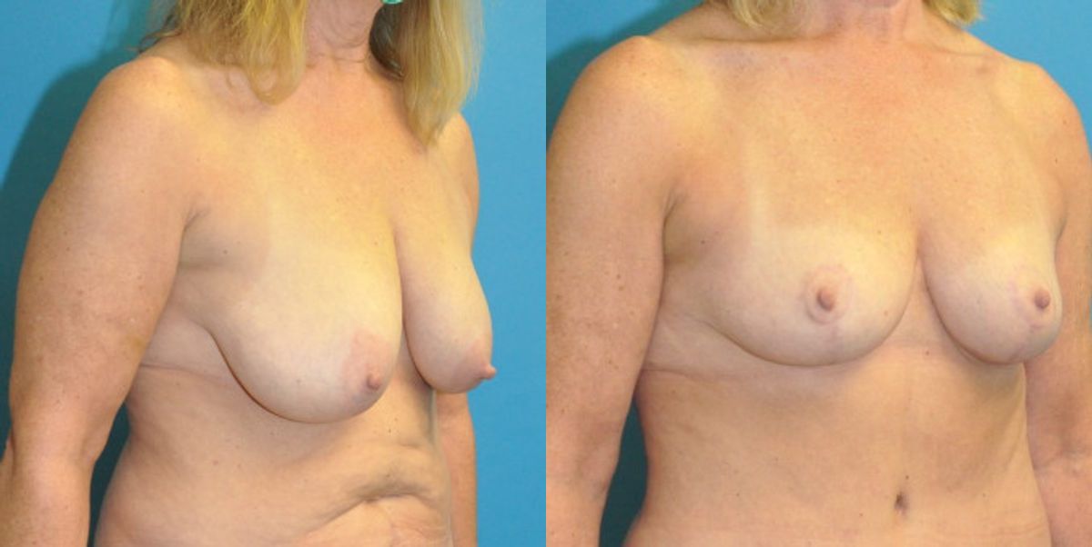 Breast Reduction #21 - Before and After