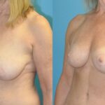 Breast Reduction #21 - Before and After