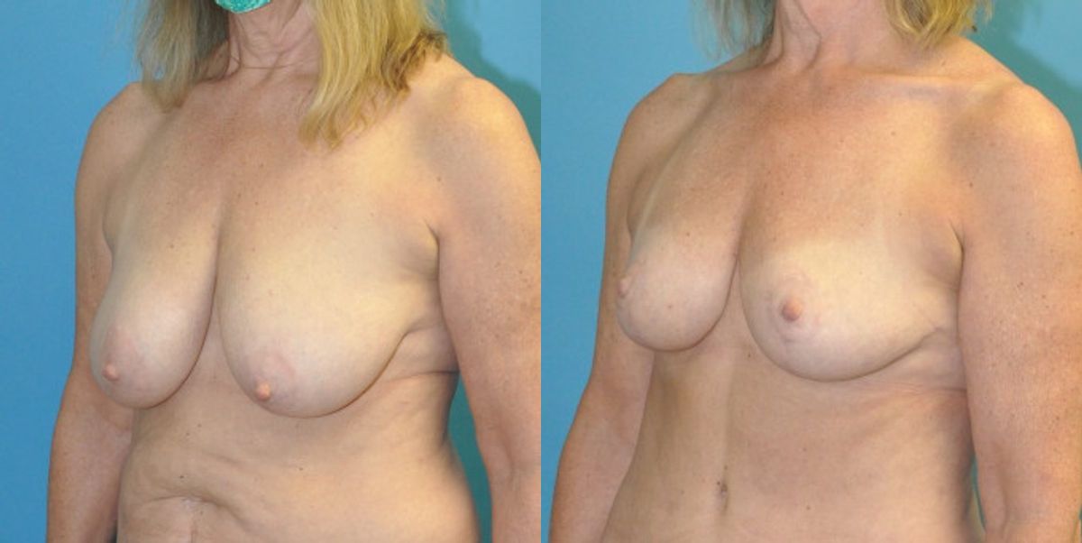 Breast Reduction #21 - Before and After