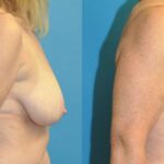 Breast Reduction #21 - Before and After