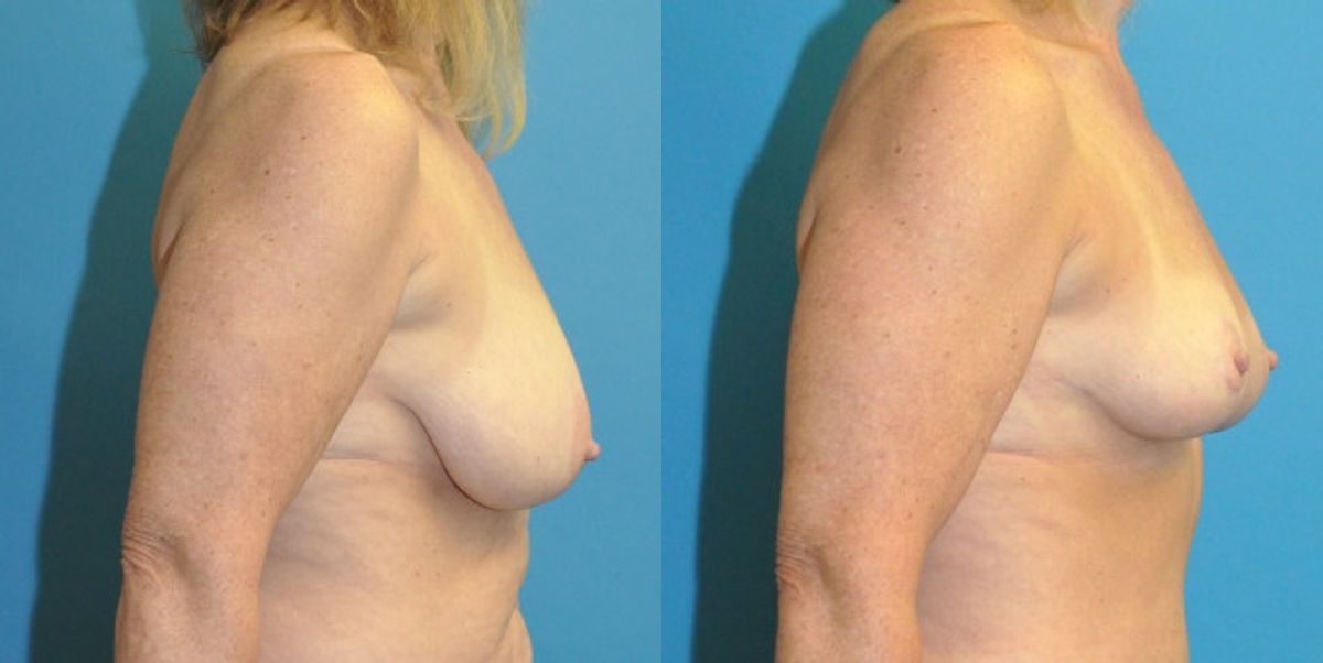 Breast Reduction #21 - Before and After