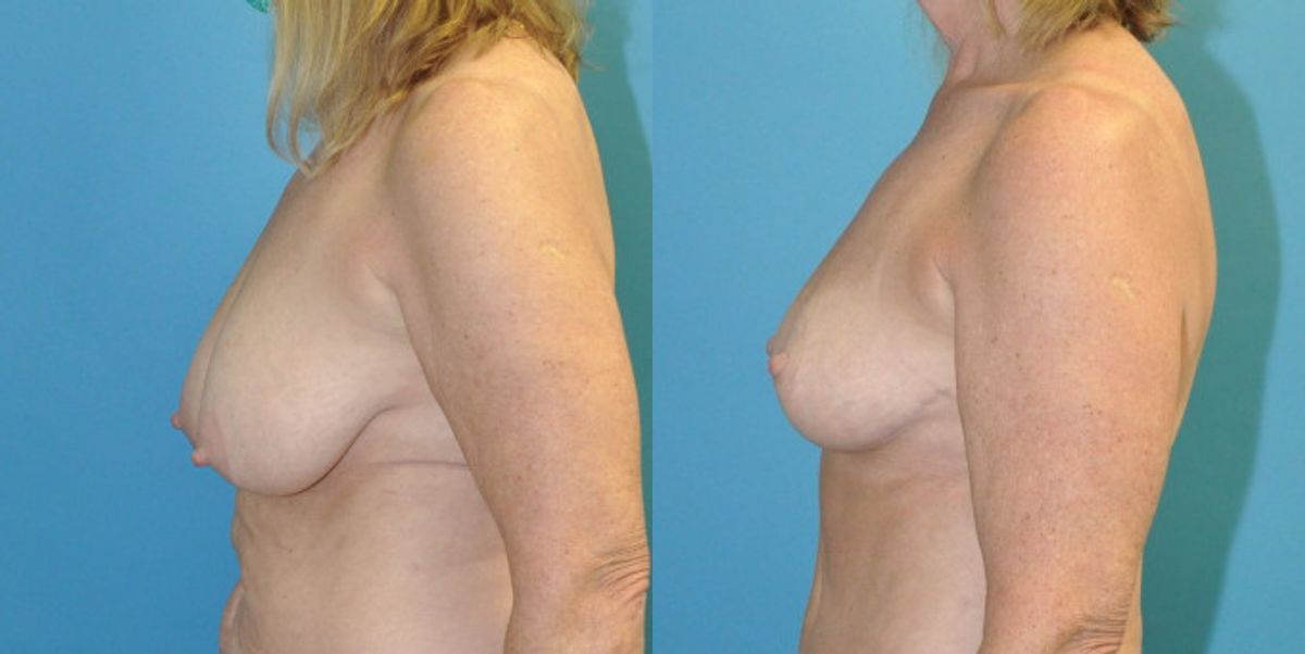 Breast Reduction #21 - Before and After