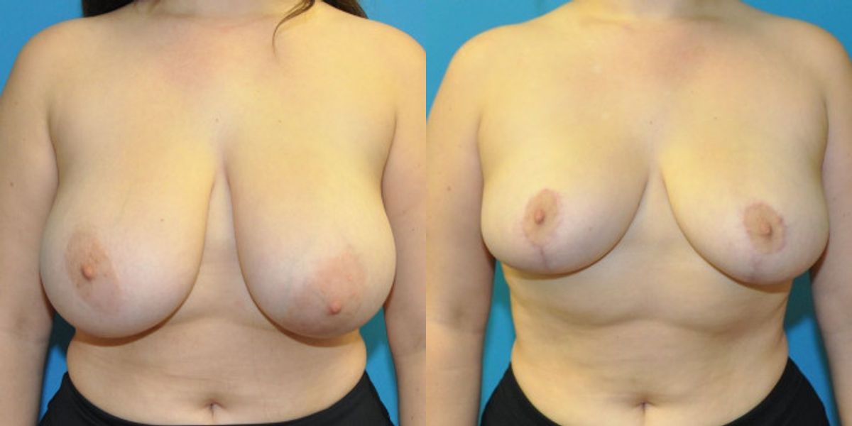 Breast Reduction #22 - Before and After