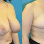 Breast Reduction #22 - Before and After
