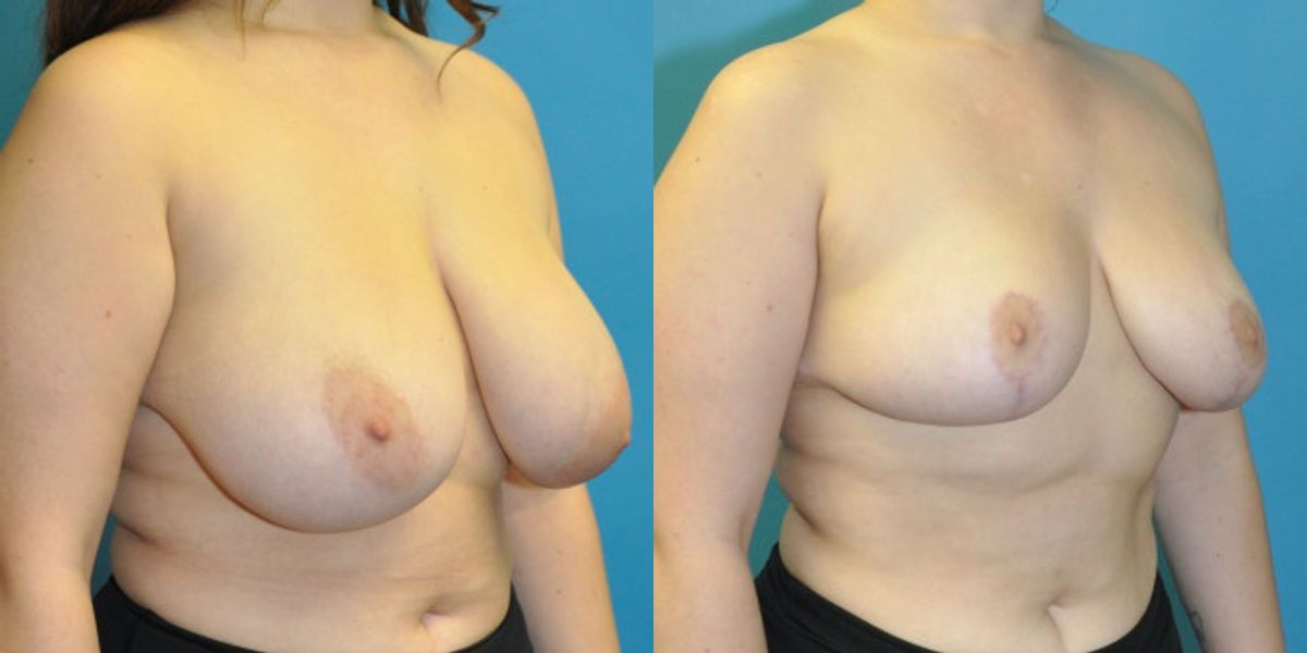 Breast Reduction #22 - Before and After