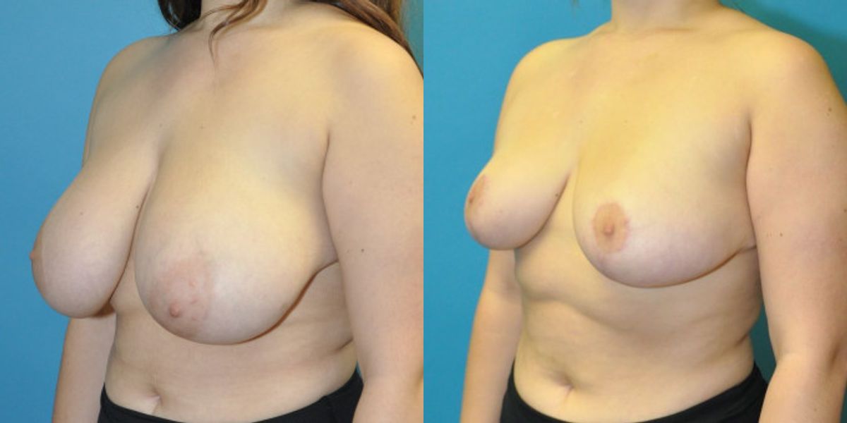 Breast Reduction #22 - Before and After