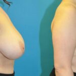 Breast Reduction #22 - Before and After