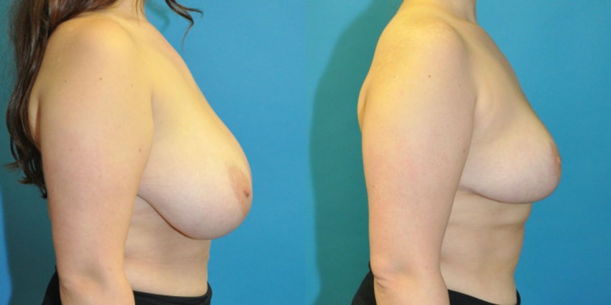 Breast Reduction #22 - Before and After