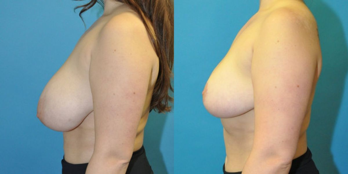 Breast Reduction #22 - Before and After