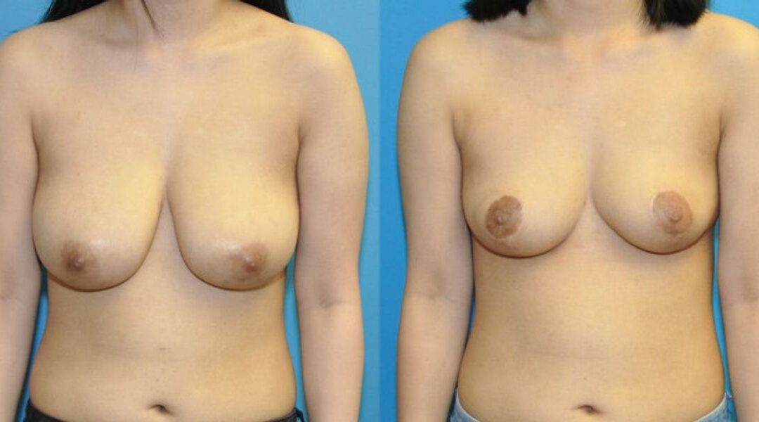Breast Reduction #23