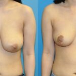 Breast Reduction #24 - Before and After