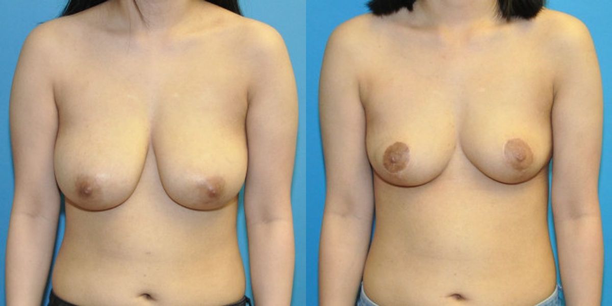 Breast Reduction #24 - Before and After