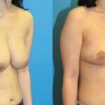 Breast Reduction #24 - Before and After