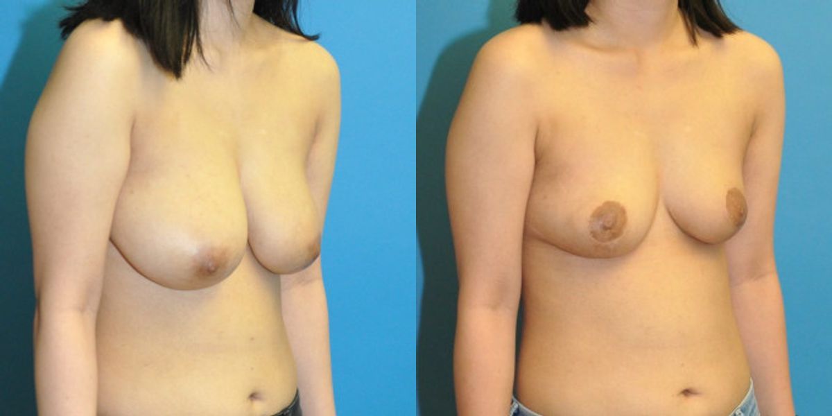Breast Reduction #24 - Before and After