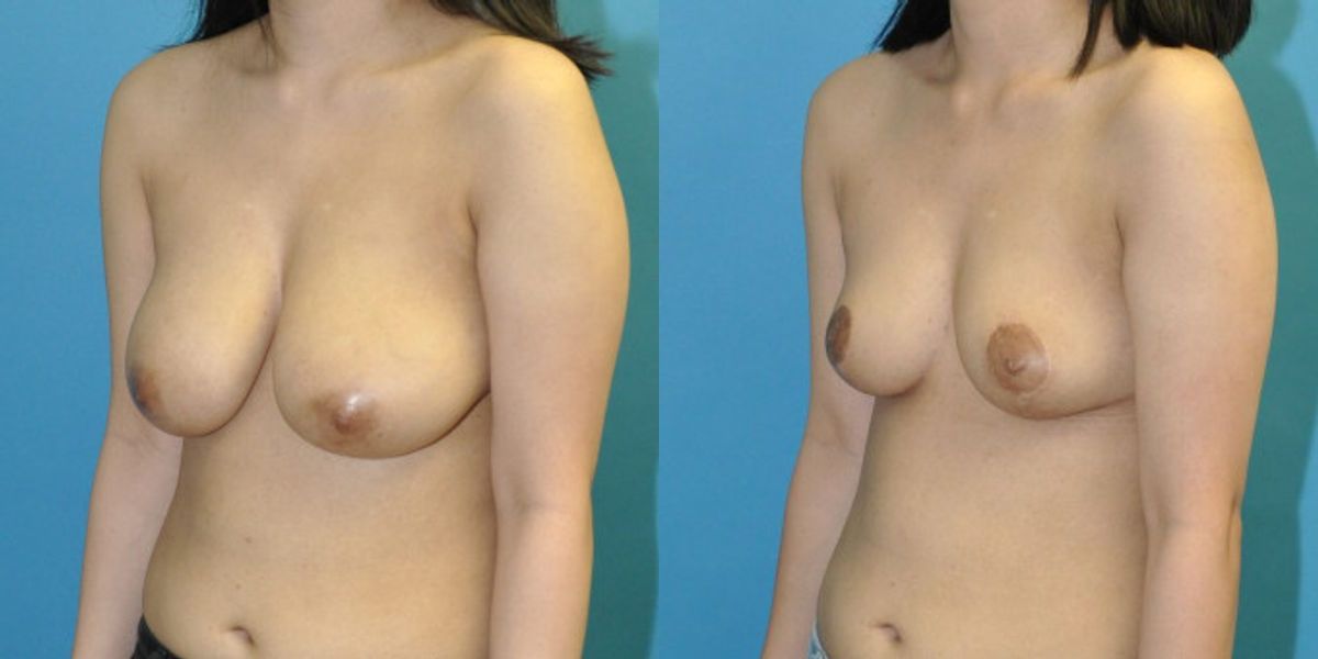 Breast Reduction #24 - Before and After