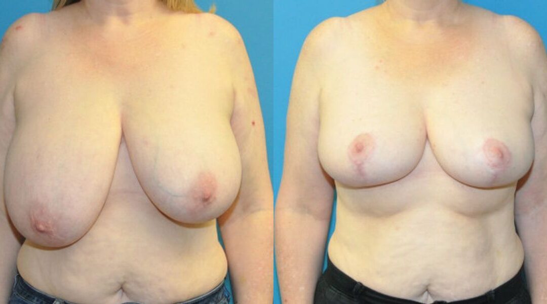 Breast Reduction #24