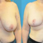 Breast Reduction #25 - Before and After