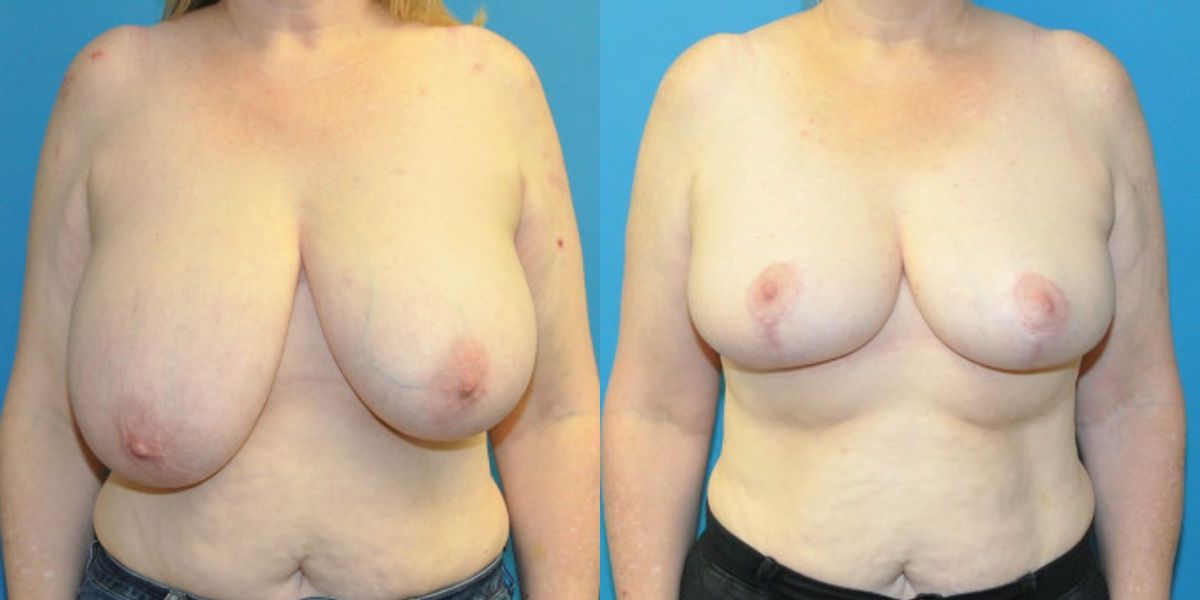 Breast Reduction #25 - Before and After