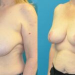 Breast Reduction #25 - Before and After