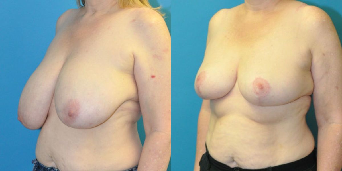 Breast Reduction #25 - Before and After