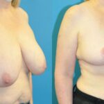 Breast Reduction #25 - Before and After