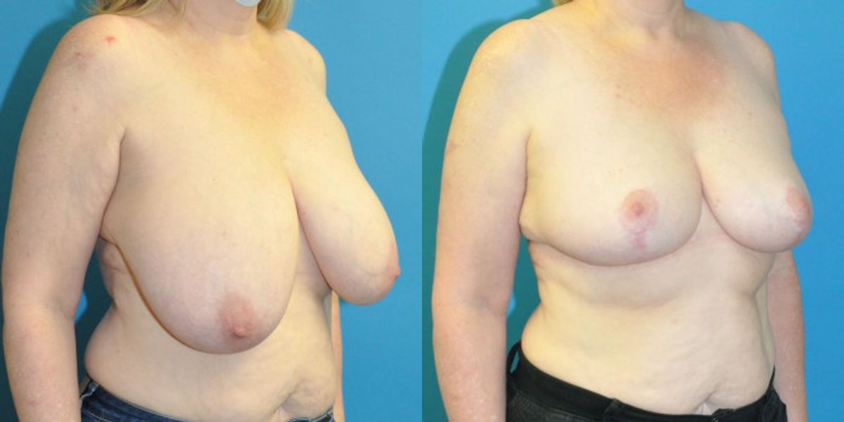 Breast Reduction #25 - Before and After