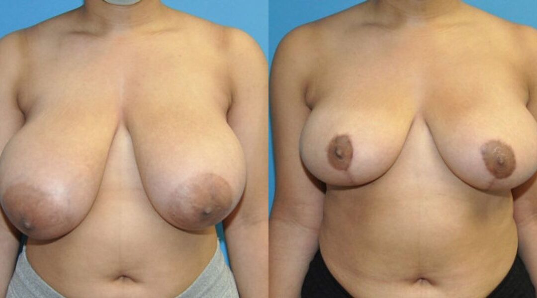 Breast Reduction #25
