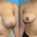 Breast Reduction #26 - Before and After
