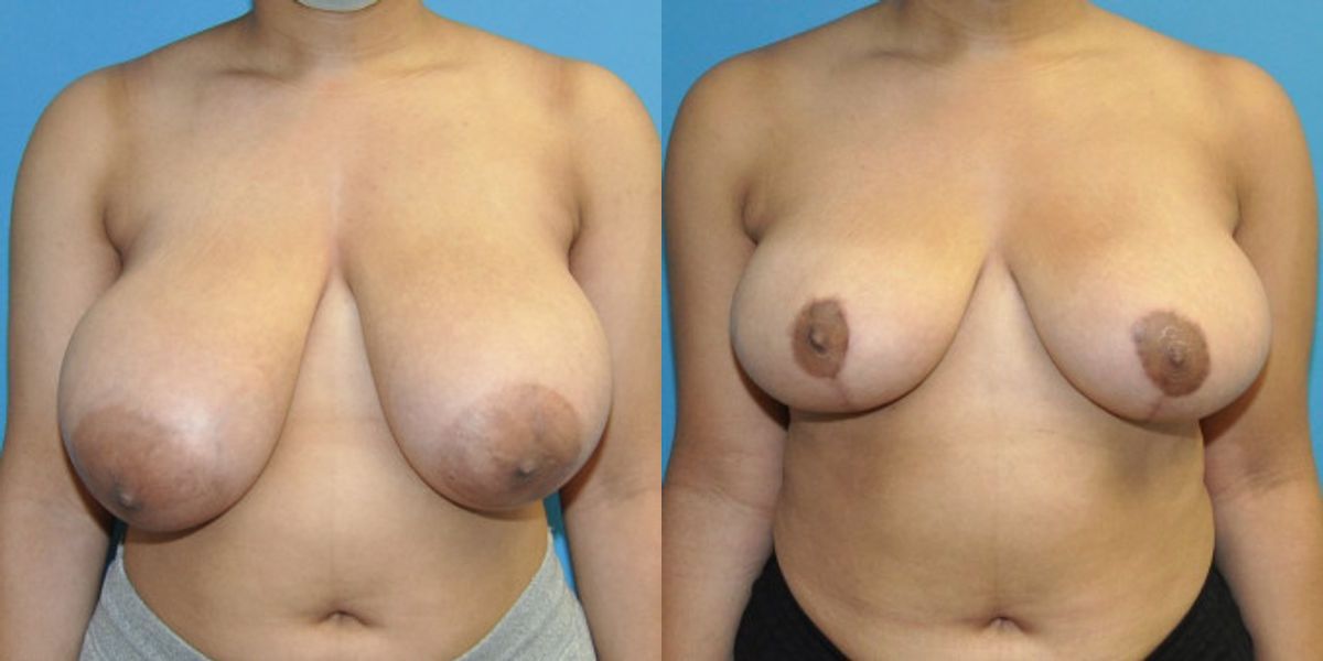 Breast Reduction #26 - Before and After