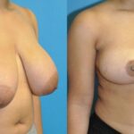 Breast Reduction #26 - Before and After