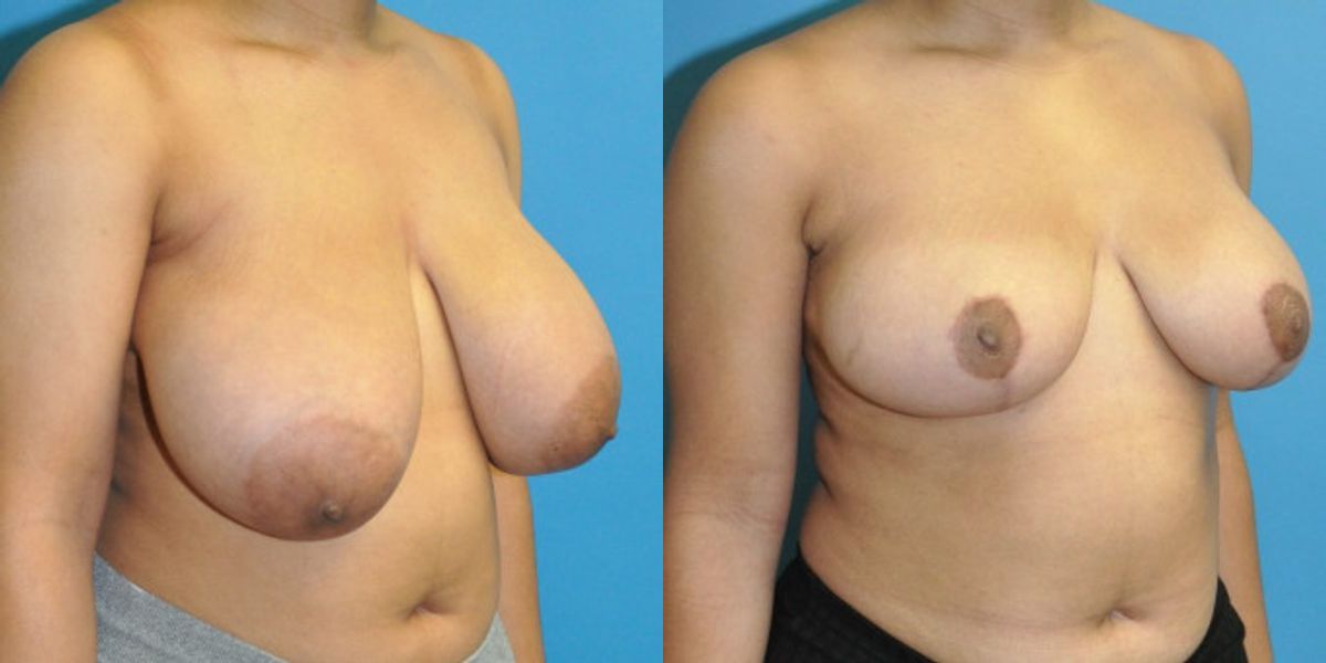 Breast Reduction #26 - Before and After