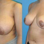 Breast Reduction #26 - Before and After
