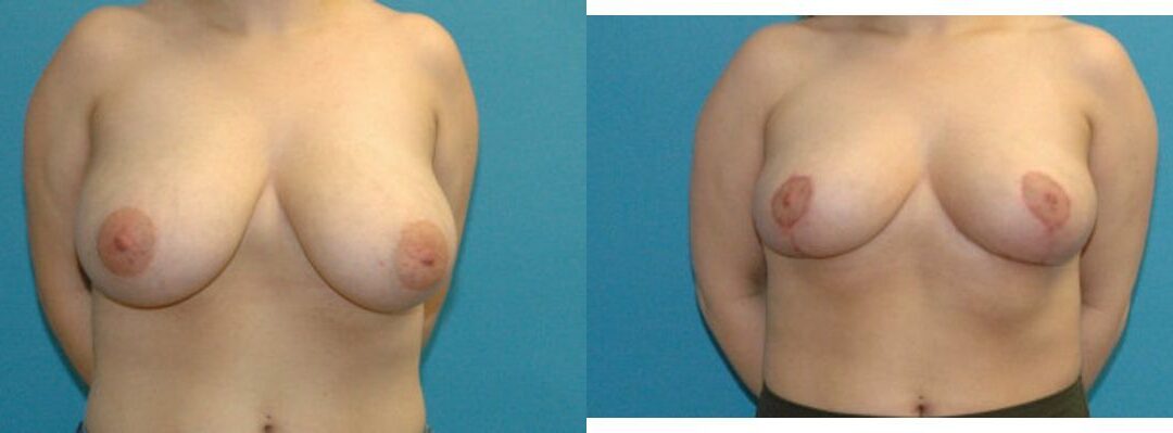 Breast Reduction #26