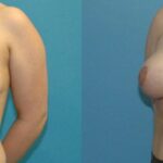 Breast Reduction #27 - Before and After