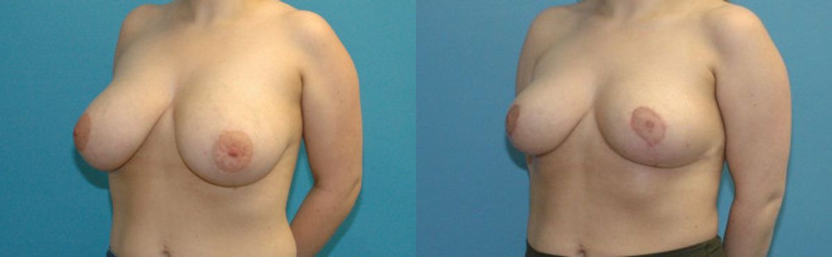 Breast Reduction #27 - Before and After