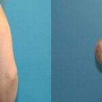 Breast Reduction #27 - Before and After