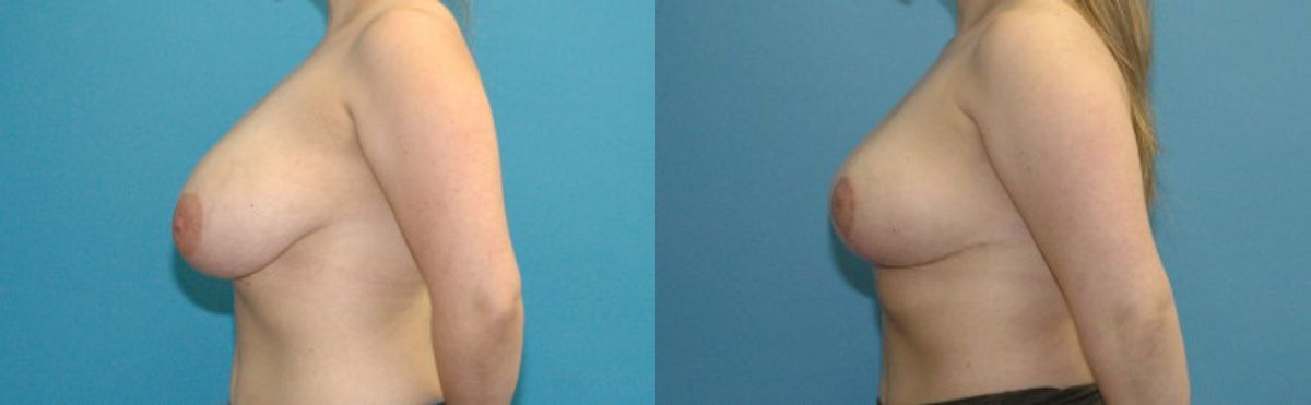 Breast Reduction #27 - Before and After