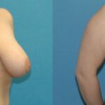 Breast Reduction #27 - Before and After