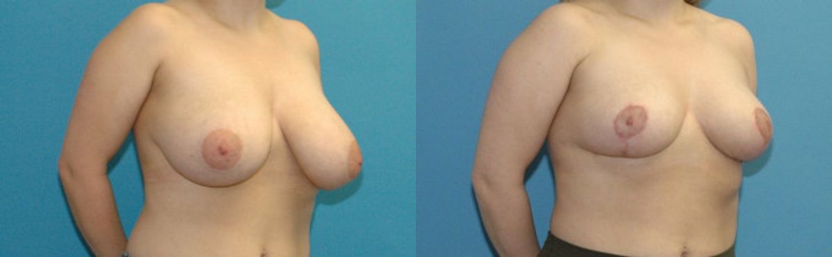 Breast Reduction #27 - Before and After