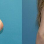 Breast Reduction #27 - Before and After