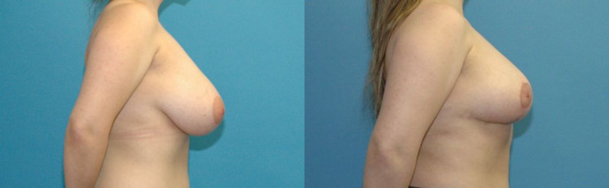 Breast Reduction #27 - Before and After