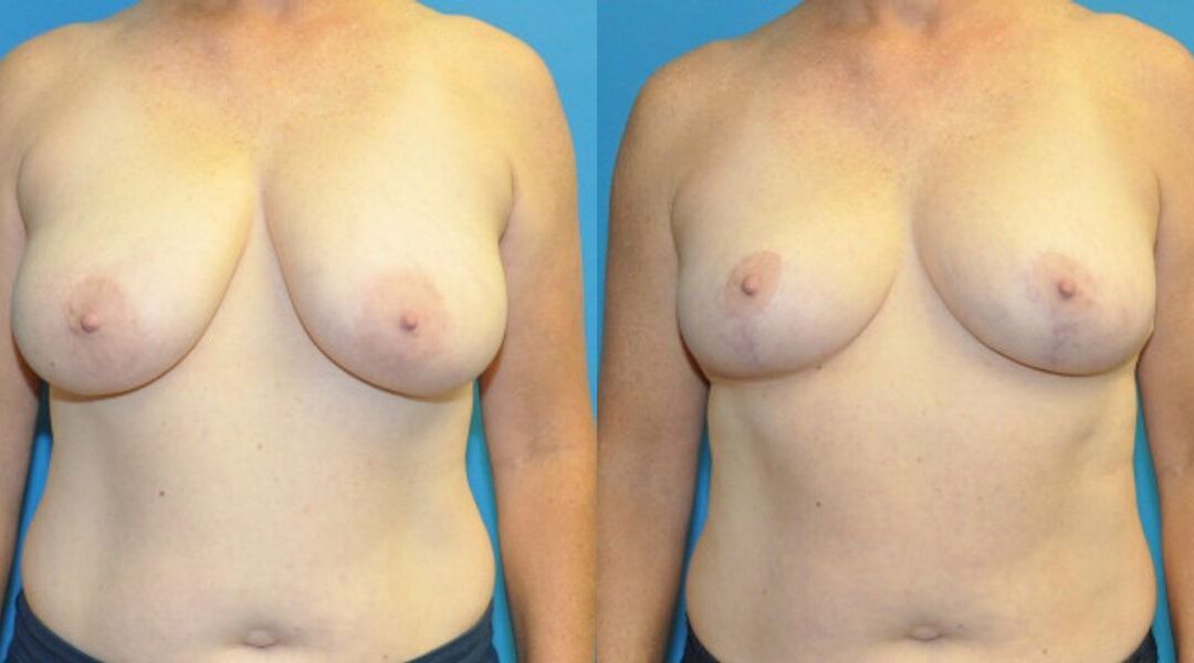 Breast Reduction #27