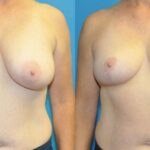 Breast Reduction #28 - Before and After