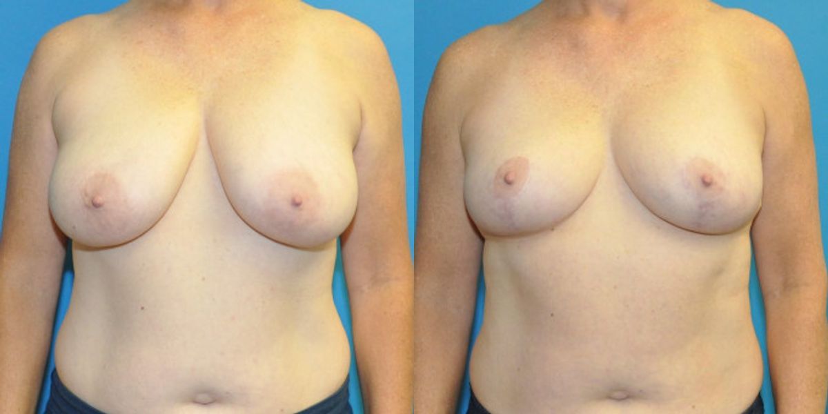 Breast Reduction #28 - Before and After