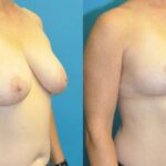 Breast Reduction #28 - Before and After