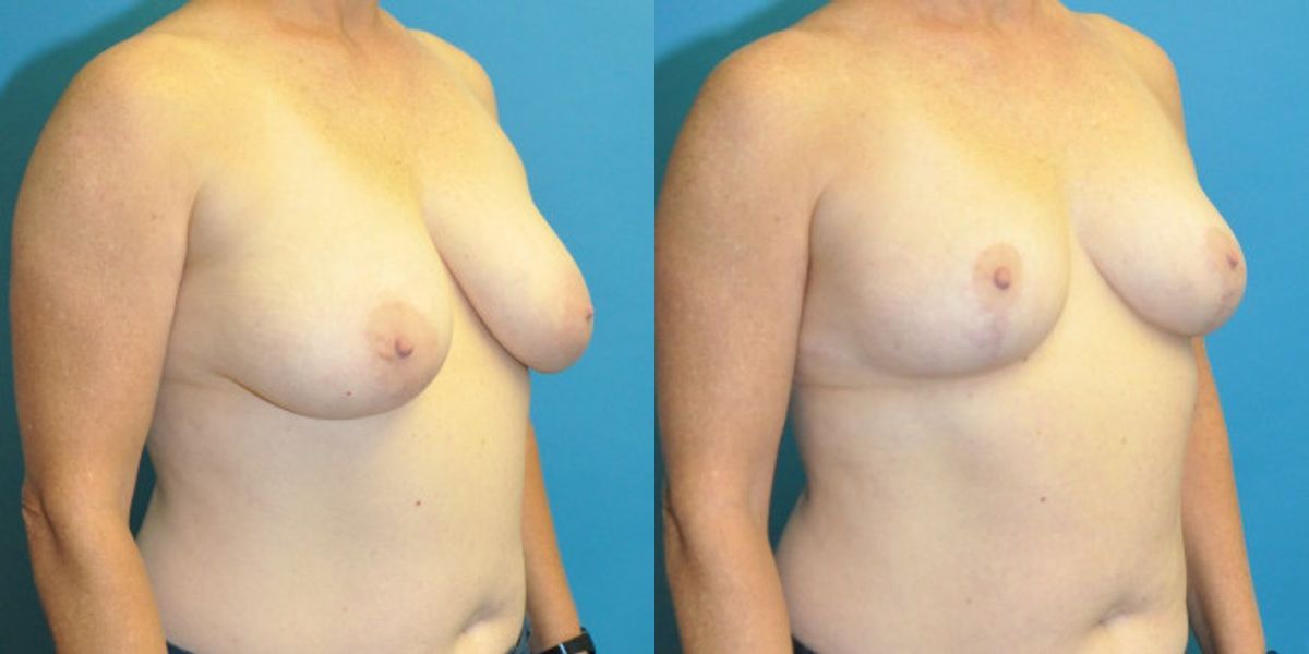 Breast Reduction #28 - Before and After